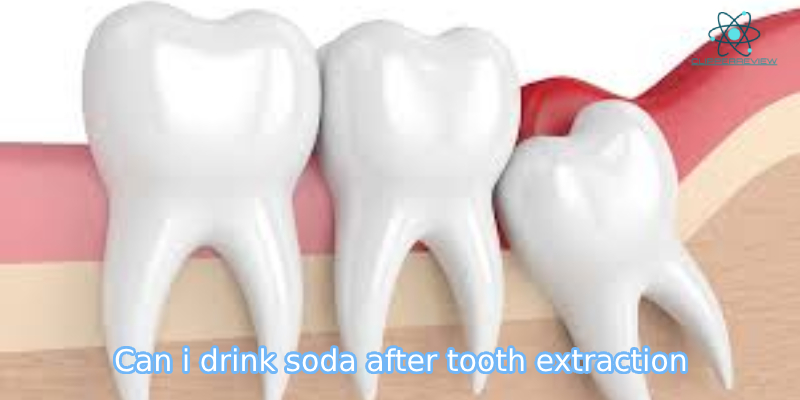 What happens if can i drink soda after tooth extraction? Alternatives to Soda